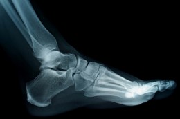 Foot X-ray