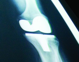 Knee X-ray