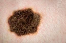 Local dermatologists to offer free skin cancer screenings May 11-15