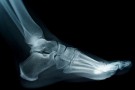 Foot X-ray